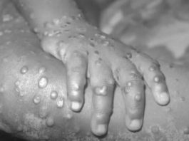 U zemlji pored naše širi se smrtonosan virus: 446 zaraženih, najugroženija je jedna grupa ljudi