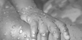 U zemlji pored naše širi se smrtonosan virus: 446 zaraženih, najugroženija je jedna grupa ljudi