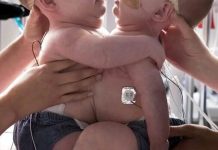 Ove sijamske blizanke rođene su spojene u području prsa i trbuha…Zbog načina na koji su njihova tijela bila povezana, čak su im i jednostavni pokreti poput uspravnog sjedenja, okretanja ili udobnog ležanja bili iznimno teški…