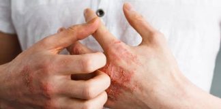 Umor, svrab, VISOK KRVNI PRITISAK, BOL U LEĐIMA – Ova bolest je ”TIHI UBICA”, obratite pažnju ako imate neke od ovih simptoma Umor, svrab, VISOK KRVNI PRITISAK, BOL U LEĐIMA – Ova bolest je ”TIHI UBICA”, obratite pažnju ako imate neke od ovih simptoma - featured image