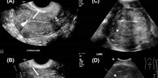 OD RAKA MATERICE UMIRE SVE VEĆI BROJ ŽENA: 6 jasnih signala da se u tijelu razvija ovaj opasan tumor! OD RAKA MATERICE UMIRE SVE VEĆI BROJ ŽENA: 6 jasnih signala da se u tijelu razvija ovaj opasan tumor! - featured image