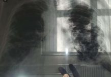OVO JE PRVI SIMPTOM RAKA PLUĆA, A NIJE KAŠALJ: Većina ljudi ga nikad ne poveže sa ovom opakom bolešću!