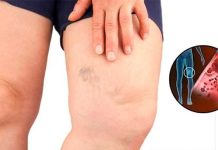 Simptomi krvnih ugrušaka u tijelu: Ako to primijetite, odmah potražite medicinsku pomoć