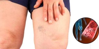 Simptomi krvnih ugrušaka u tijelu: Ako to primijetite, odmah potražite medicinsku pomoć