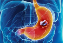 5 ranih simptoma raka želuca: Tumor može da raste godinama, a svi pacijenti prvo osjete ovo