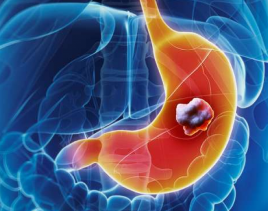 5 ranih simptoma raka želuca: Tumor može da raste godinama, a svi pacijenti prvo osjete ovo